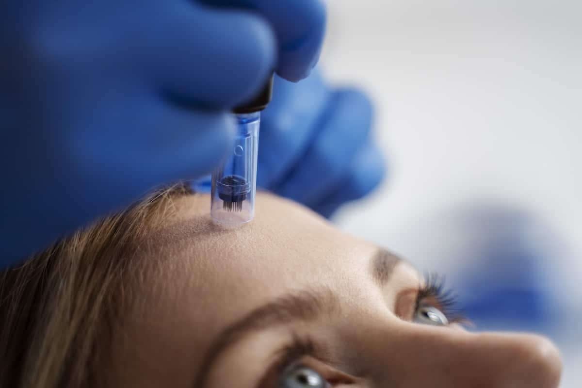 Professionelle Microneedling-Behandlung im Beauty Royal Kosmetikstudio in Brüggen für glatte, strahlende Haut und verfeinerte Poren